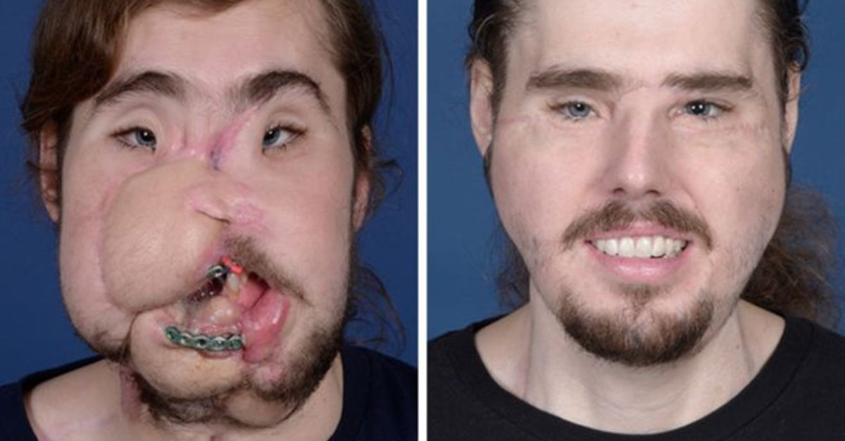 Homem sem rosto volta a sorrir após operação de 25 horas