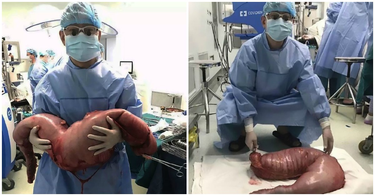 Cirurgiões removeram pedaço de intestino com 13 quilos de homem com doença rara